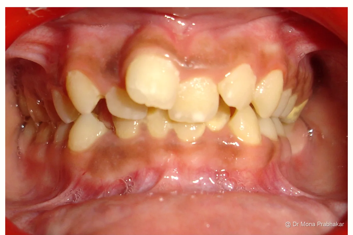 Upper front teeth out of position before treatment