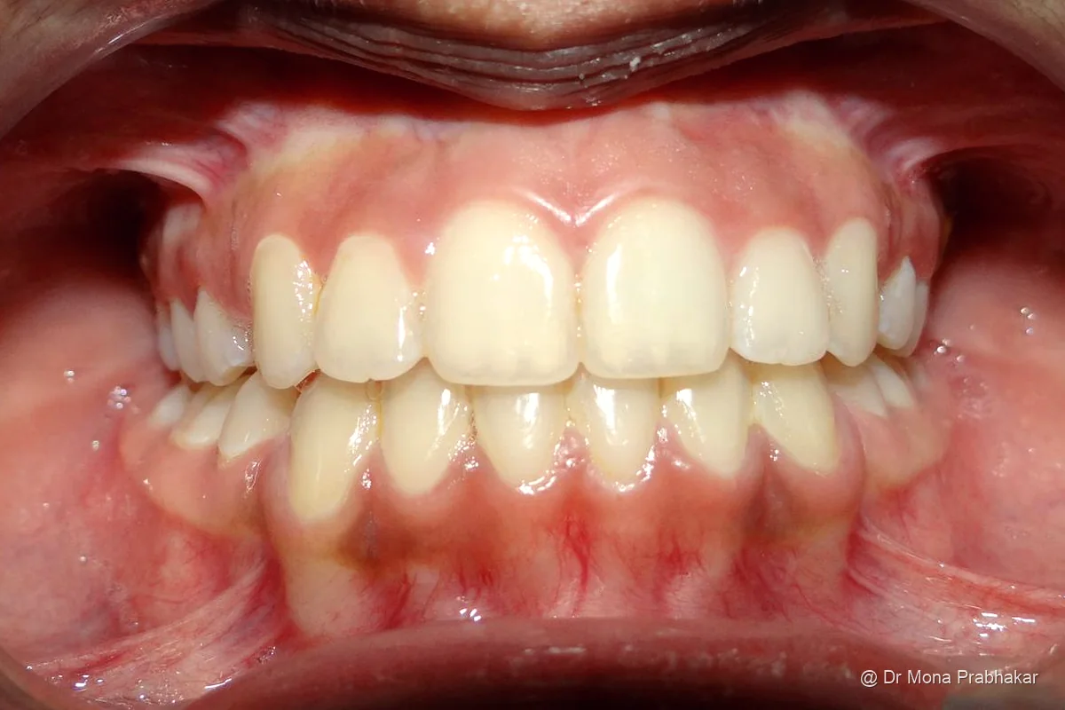 Teeth evenly positioned in the dental arch after treatment