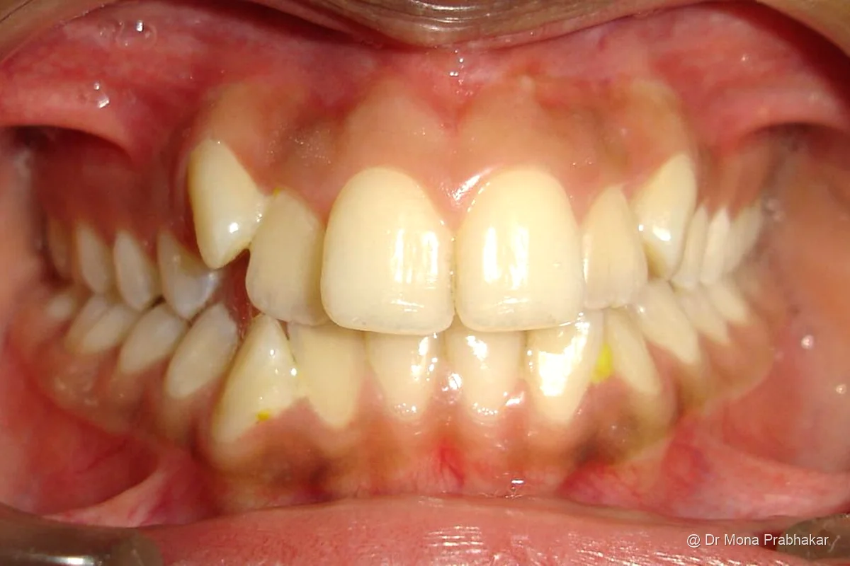Highly placed upper canine teeth before treatment