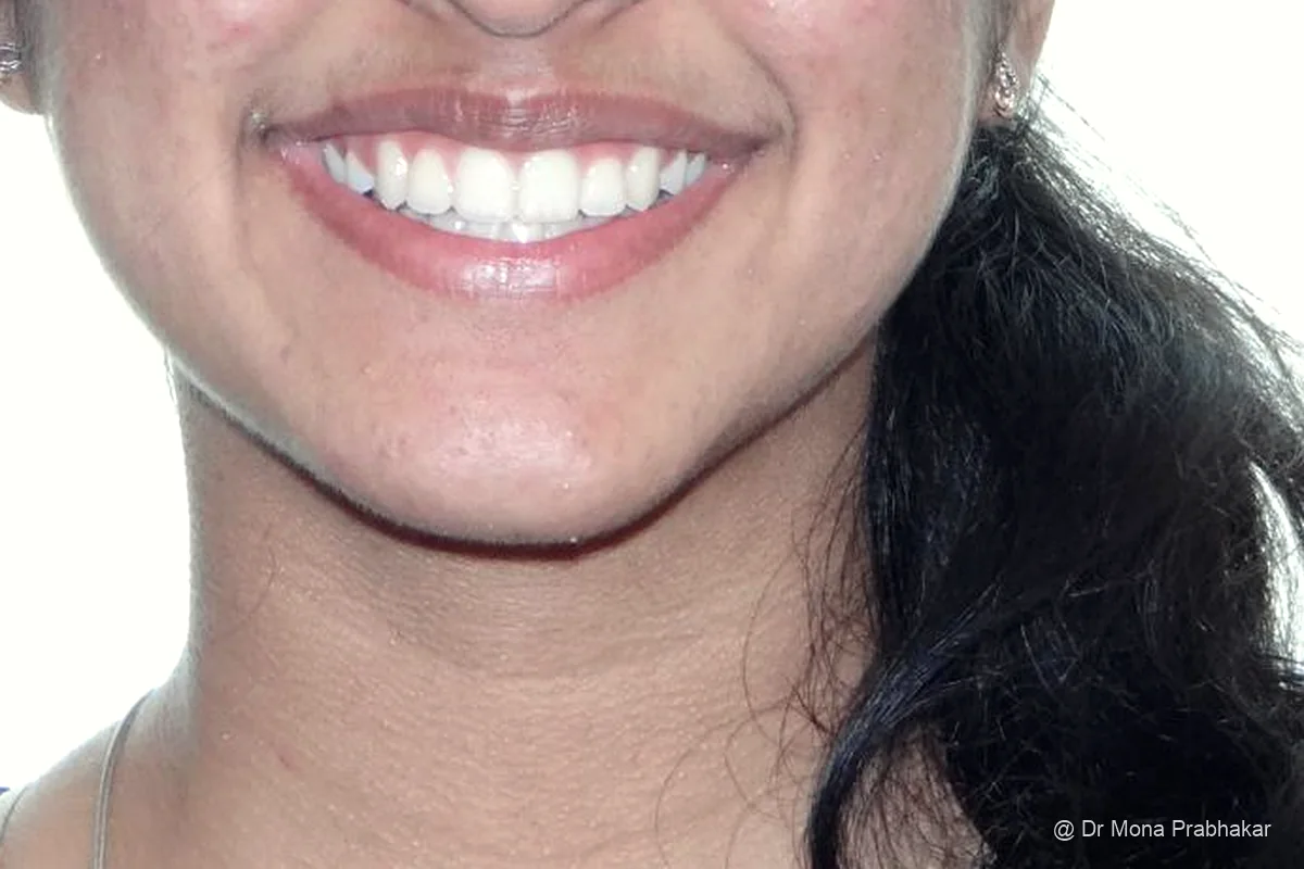 Smile after the upper canine teeth were aligned