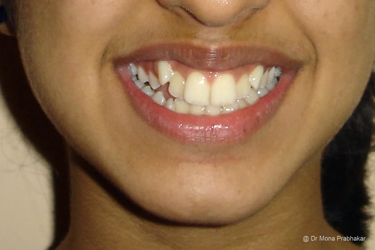 Smile before treatment, upper canine out of line