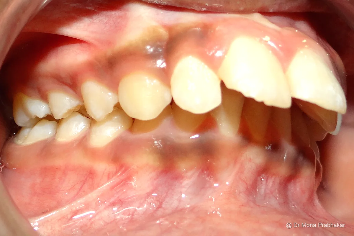 Protruded upper front teeth before treatment