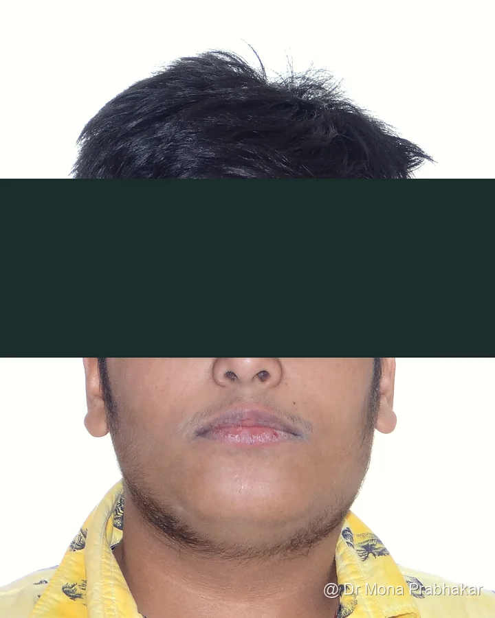 Patient front view after treatment, eyes and eyebrows redacted