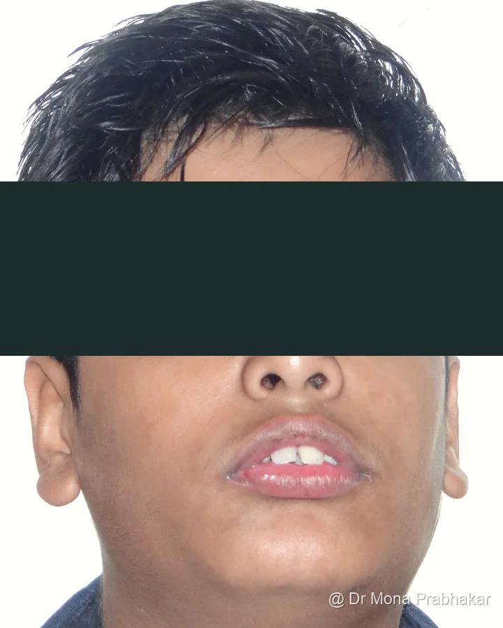 Patient front view before treatment, eyes and eyebrows redacted