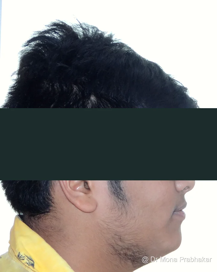 Patient profile after treatment, showing the jaw change