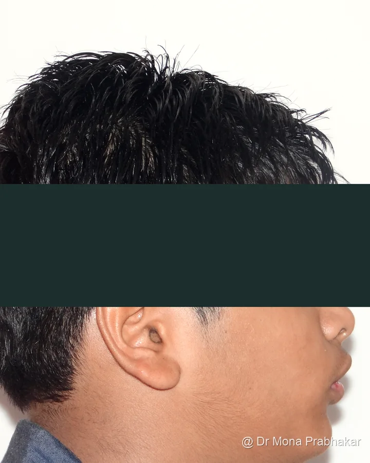 Patient profile before treatment, eyes and eyebrows redacted